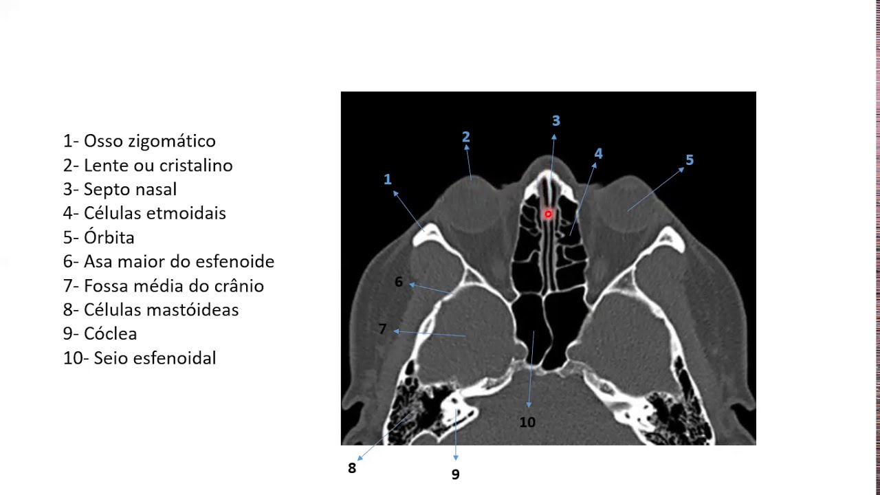 Crânio por imagens de tomografia computadorizada