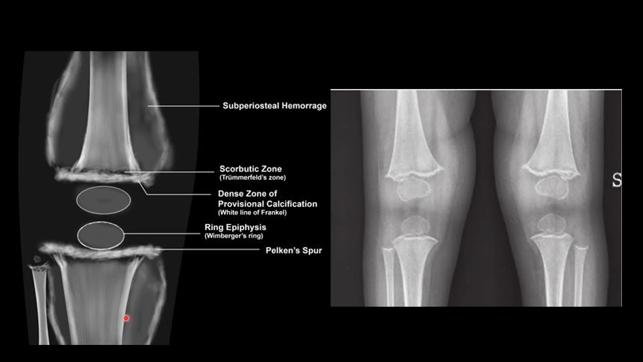 SCURVY VS RICKETS- RADIOLOGY