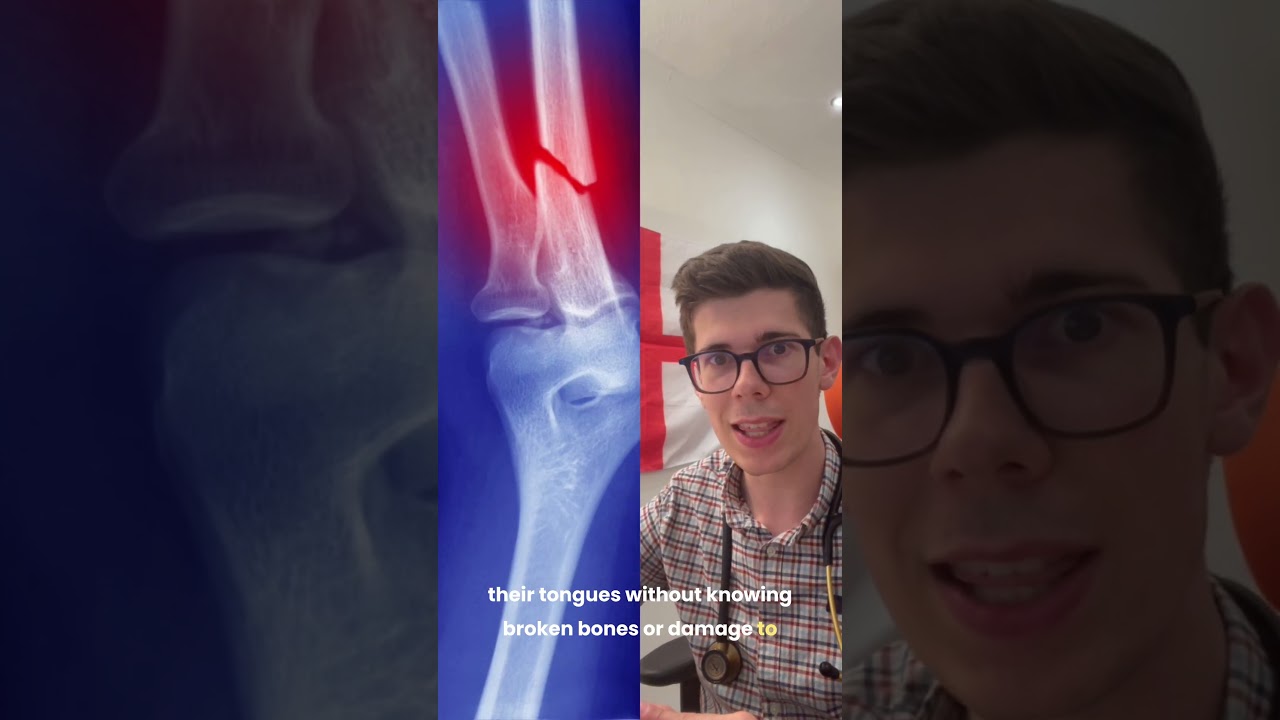 Doctor Explains The People Who Can't Feel Pain
