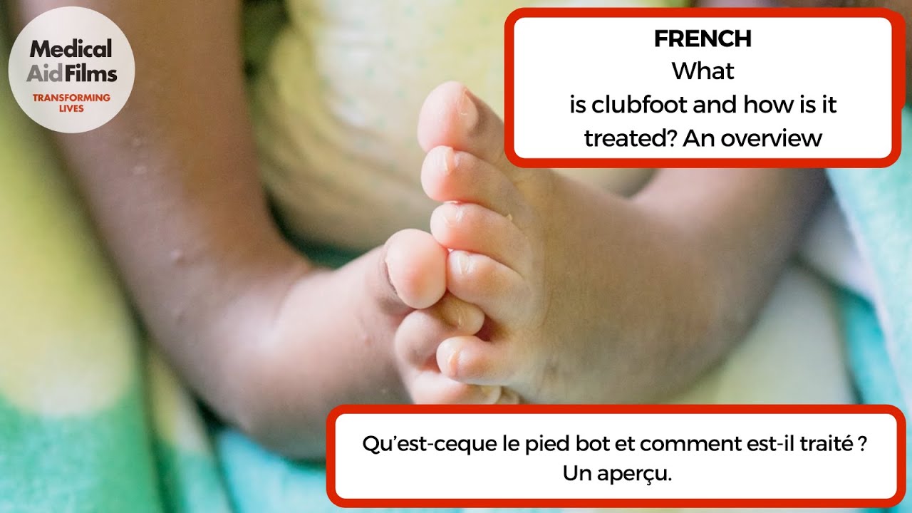 Qu’est-ce que le pied bot et comment est-il traité ? Un aperçu.