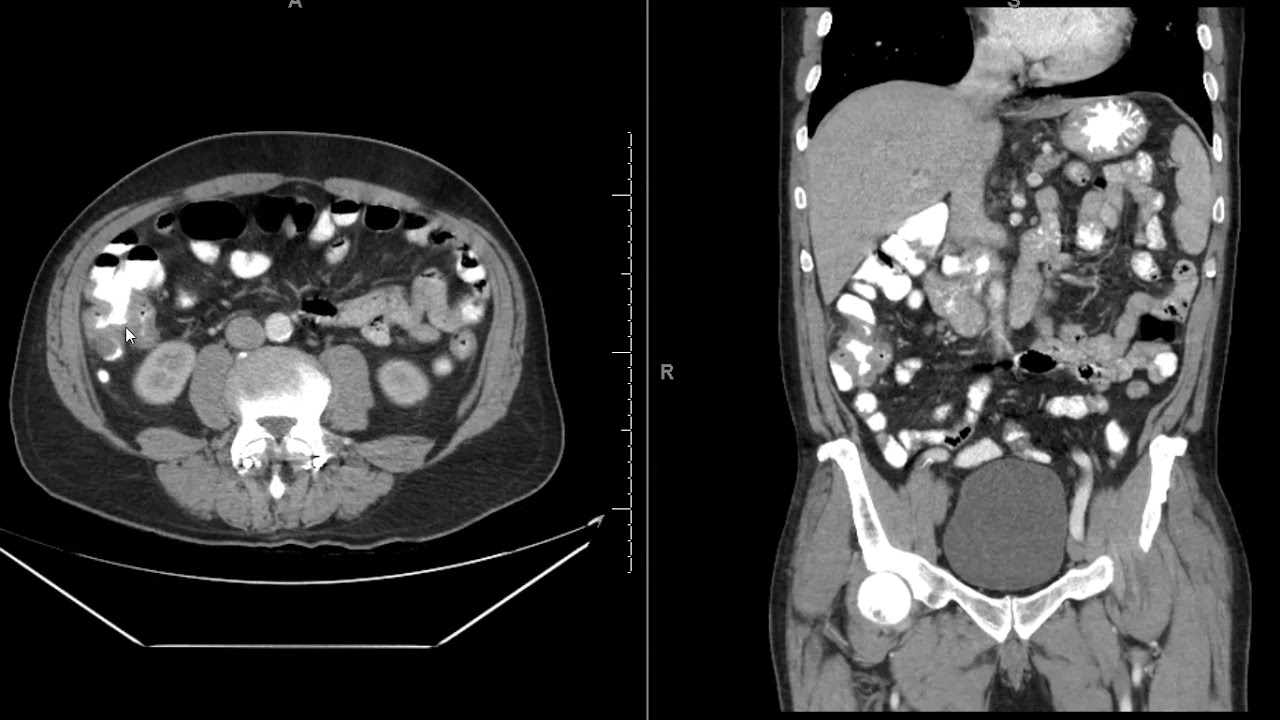 cecal ca with ileocolic nodes
