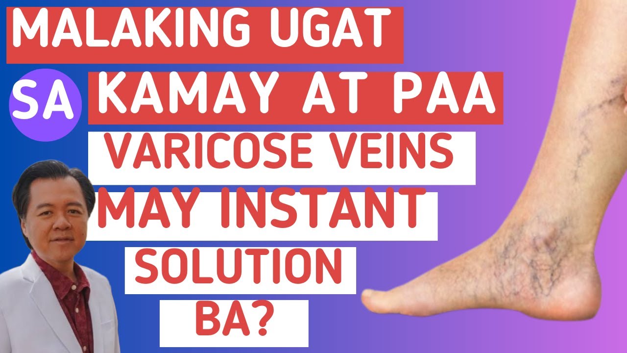 Malaking Ugat sa Paa at Kamay. Varicose Veins: May Instant Solution Ba?