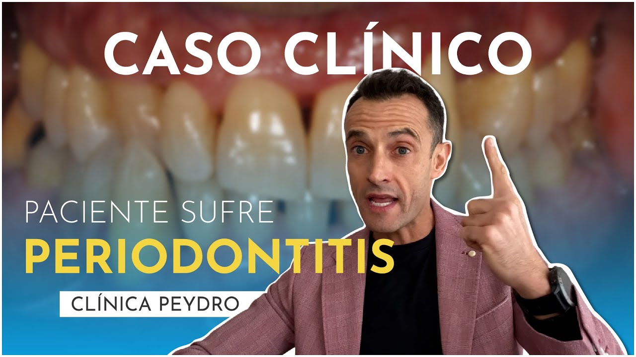 PERIODONTITIS tratamiento. La periodontitis tiene cura