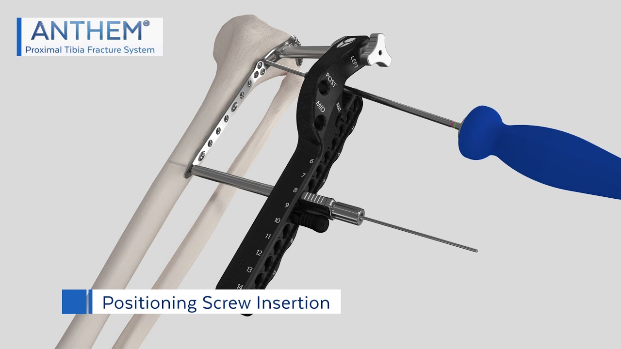 ANTHEM&reg; Proximal Tibia Fracture System