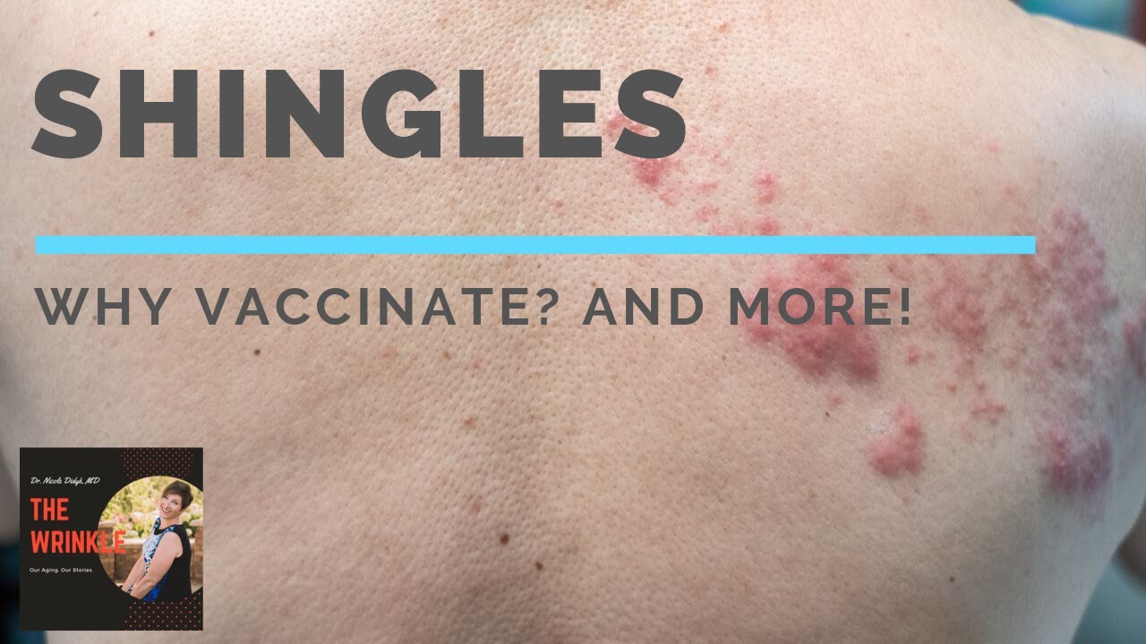 Shingles - why vaccinate, and more!
