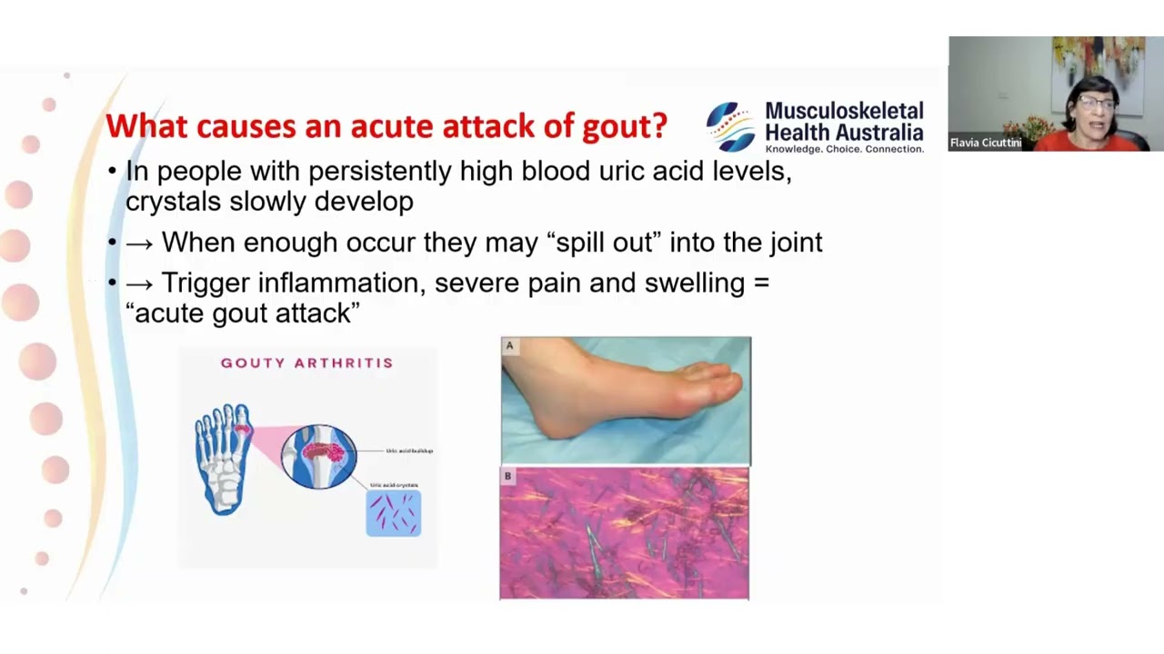 Gout   Your questions answered