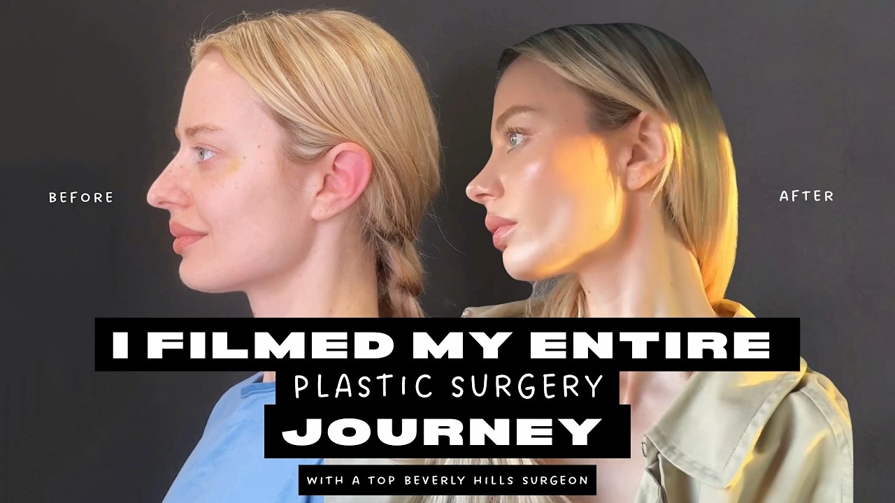 I Got A Rhinoplasty & Breast Augmentation On The Same Day (Beverly Hills Plastic Surgery Vlog + Q&A)