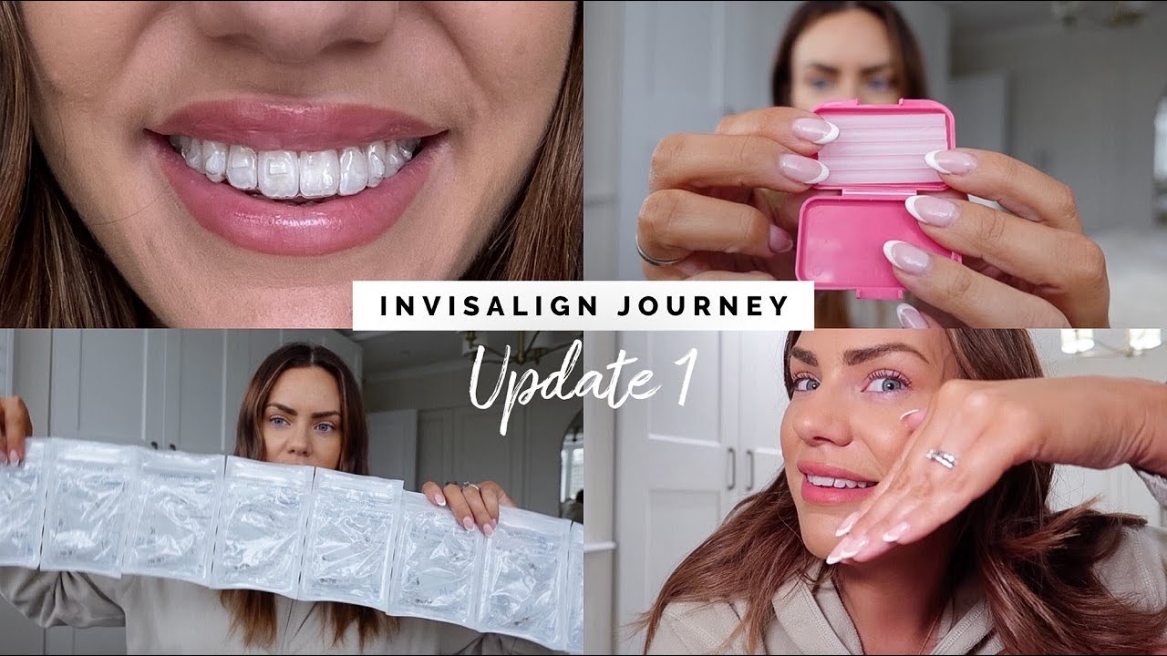 Я купила Invisalign! Зачем? На сколько? Крепления? | Обновление 1 для INVISALIGN