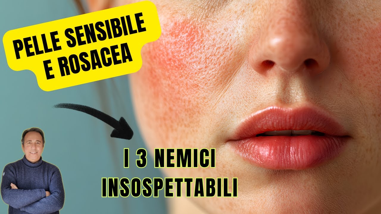 I 3 cibi insospettabili che infiammano la Rosacea