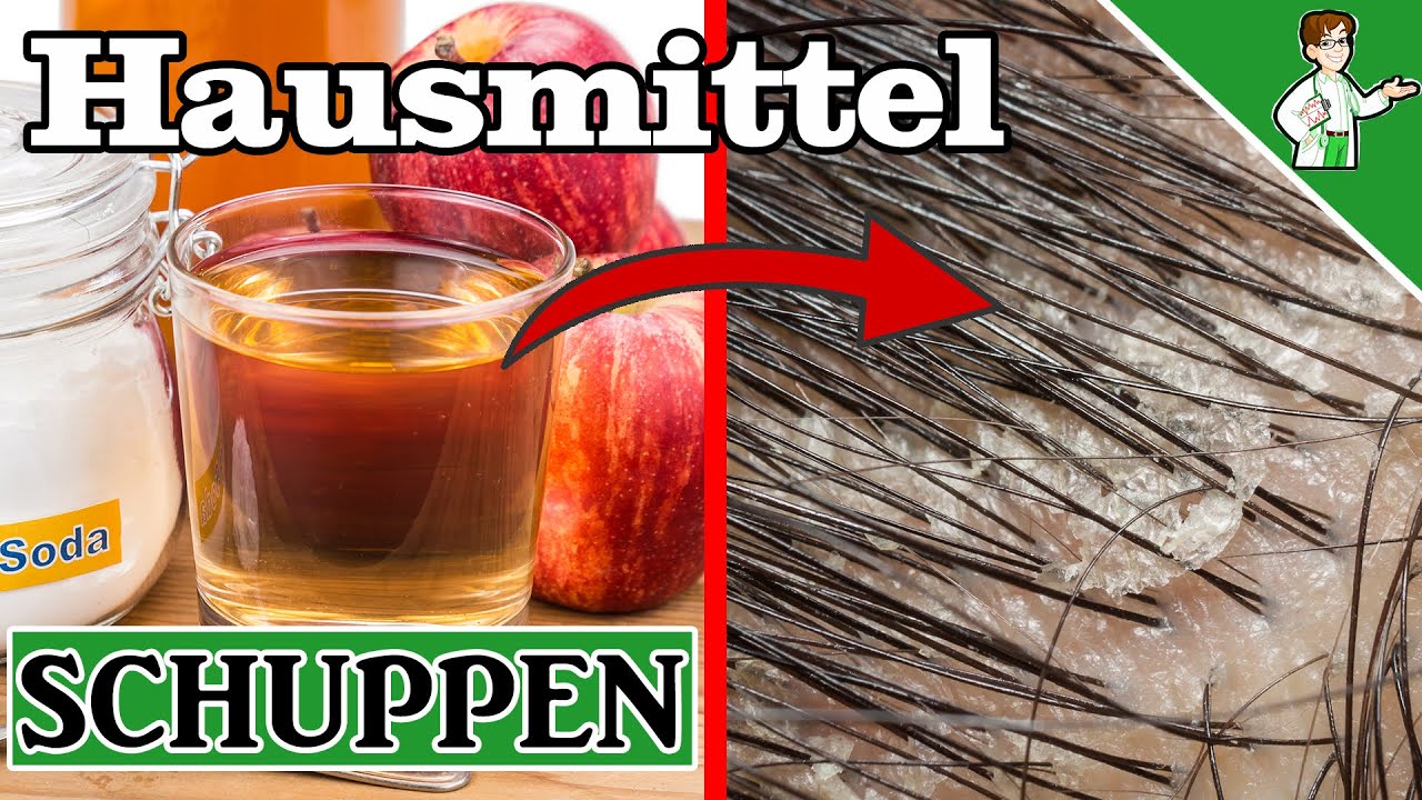Hausmittel gegen Schuppen - Die Top 7 Tipps 💇💇&zwj;