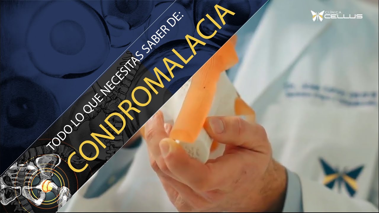 Condromalacia o Condropatía Rotuliana. Despeja todas tus dudas sobre cómo tratarla y prevenirla.