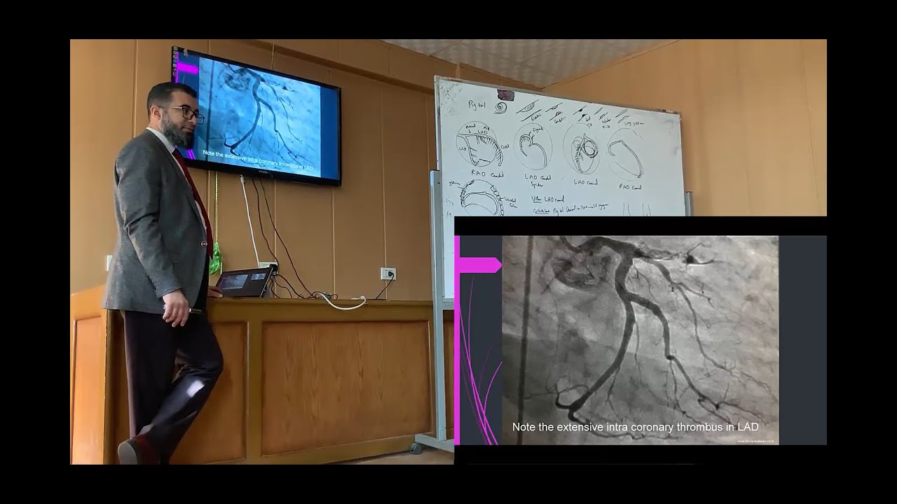 Cardiac Cath Tracing 1 (Coronary Angiography)