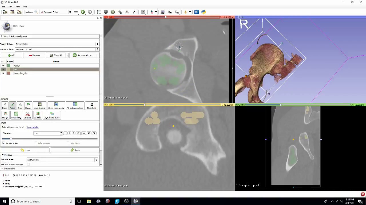 DICOM to STL Conversion Tutorial with Segment Editor