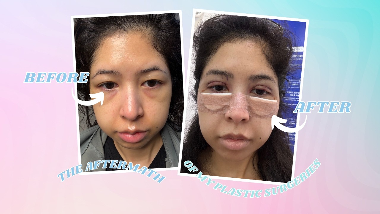 The aftermath of double eyelid surgery in Korea