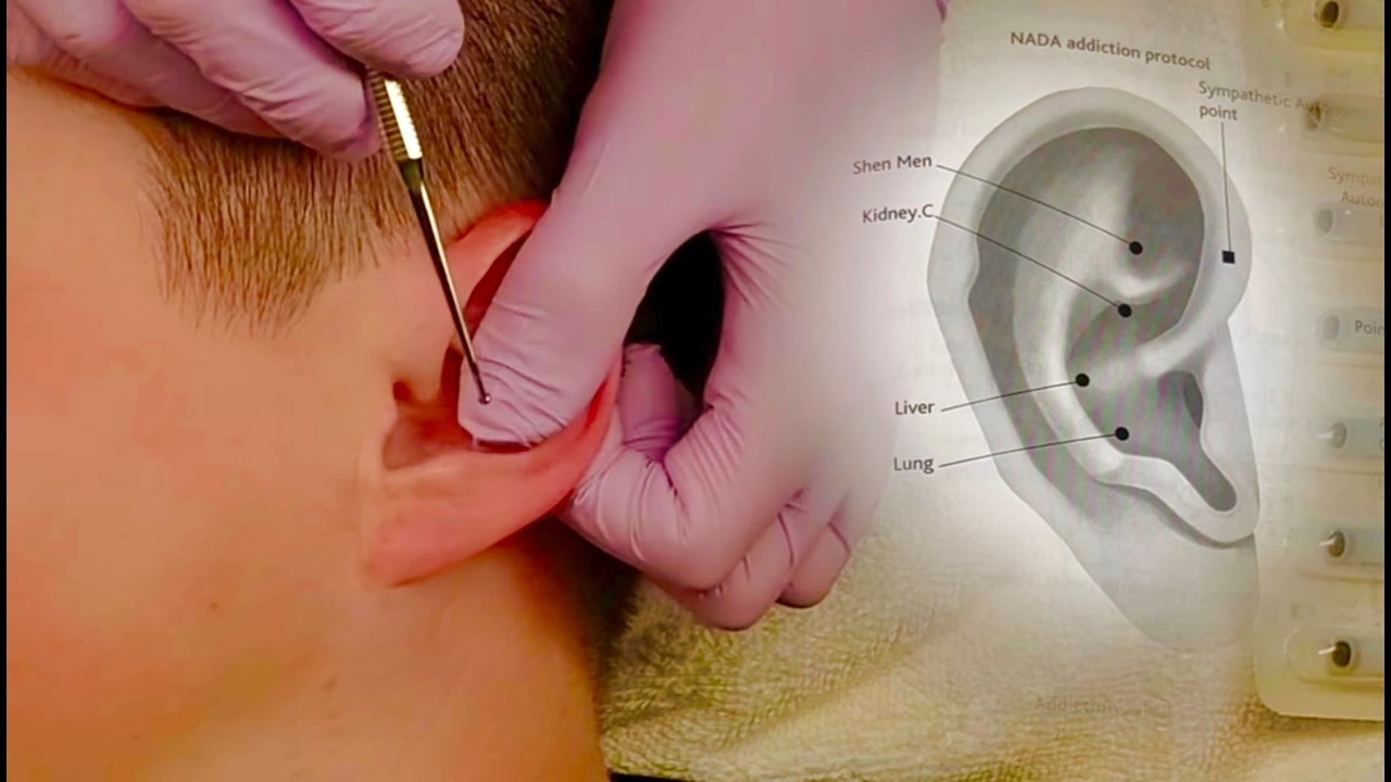 Ear Seeding for Migraines, Sciatica, Asthma, and Addiction👂🏼 [Natural Speaking ASMR] 🧡 NO MUSIC