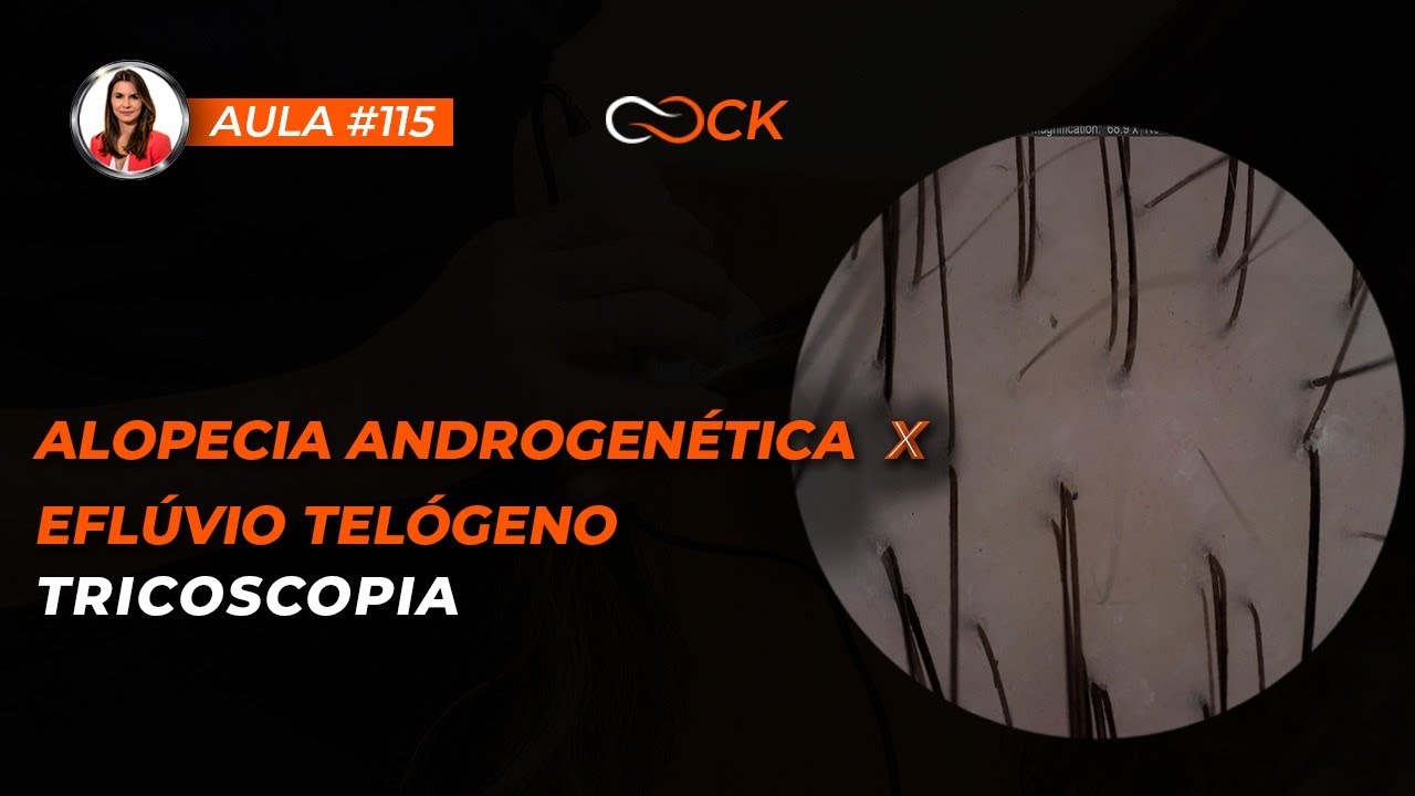 #Aula 115 - Tricoscopia: Alopecia Androgenética x Eflúvio Telógeno