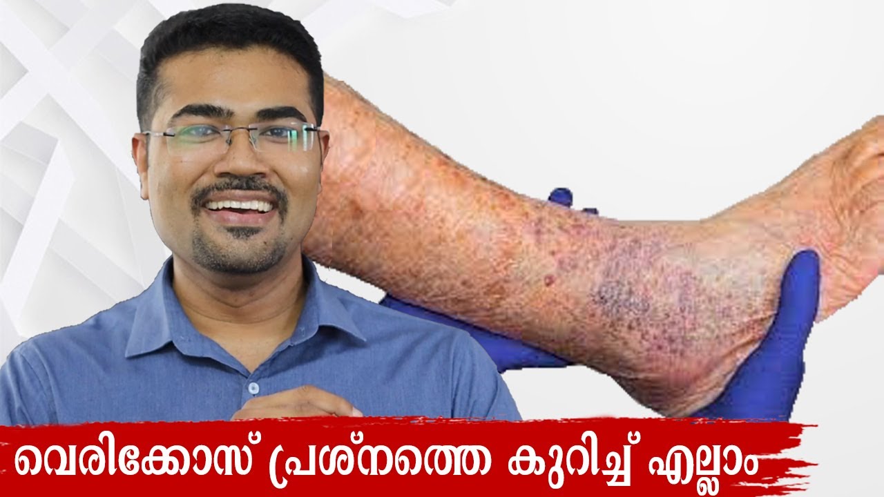 All About Varicose Problem - Dr Manoj Johnson