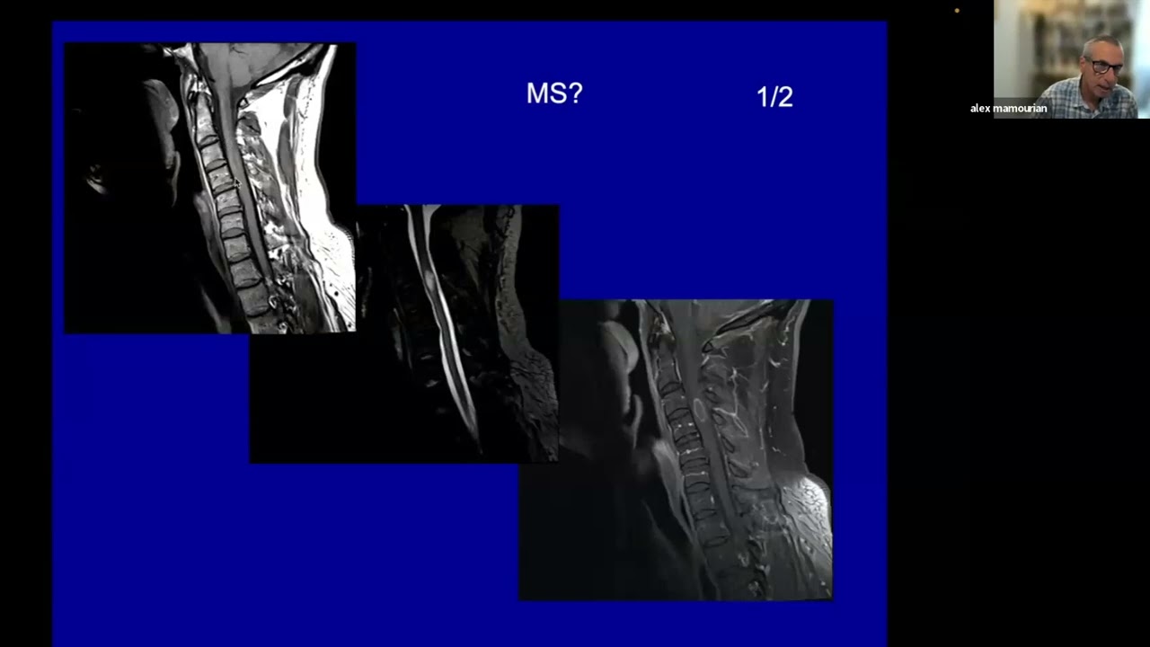 Imaging of MS and mimics  HD 1080p