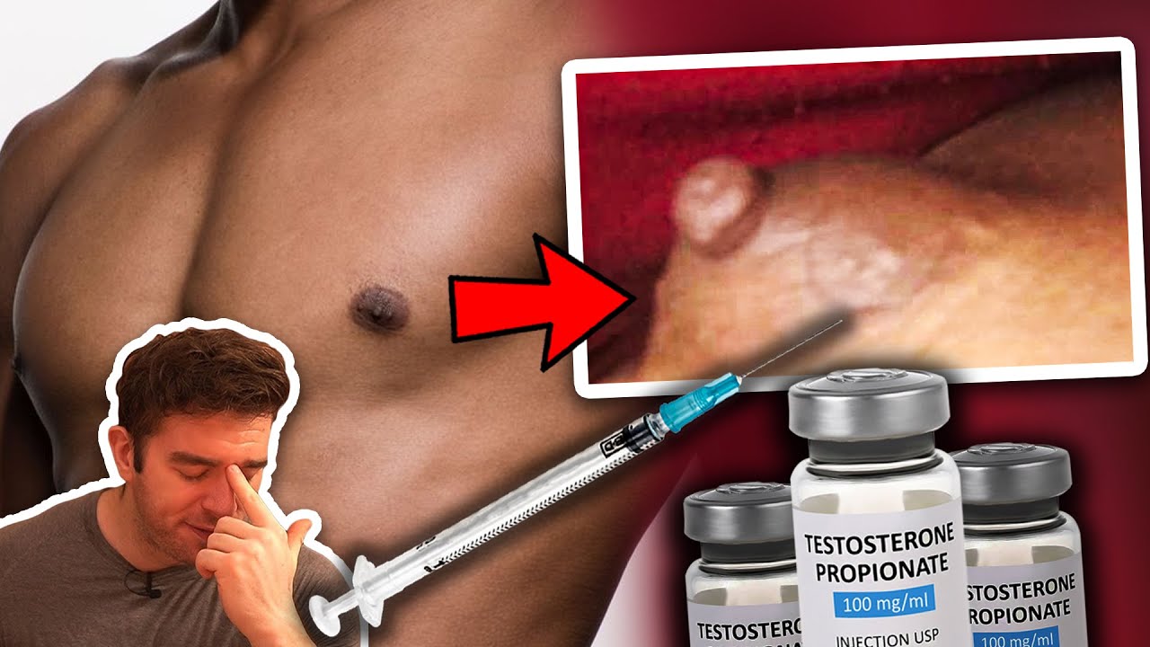 He Injected Testosterone Into His Gyno And This Is What Happened...
