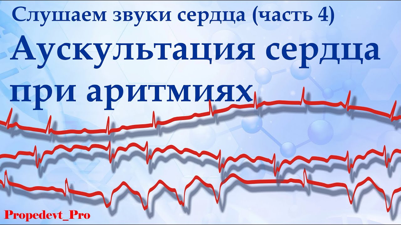 Слушаем звуки сердца (4). Аускультация сердца при аритмиях