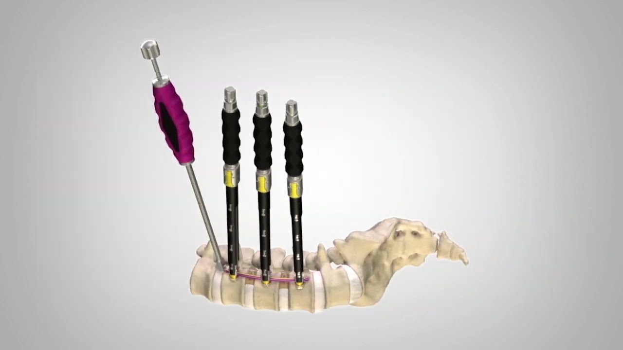 StruXure™ Lateral Deformity Fixation System