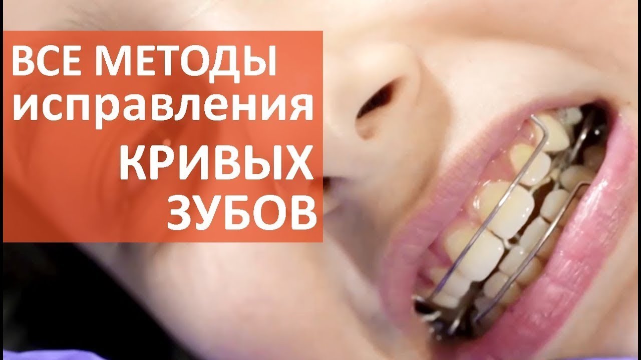 Кривые зубы что делать. 😁 Как сделать выбор метода исправления кривых зубов. Мать и Дитя Кунцево.