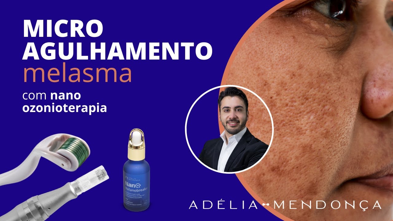 Protocolo Microagulhamento para Melasma com Nano Ozonioterapia - por Heitor Cruz