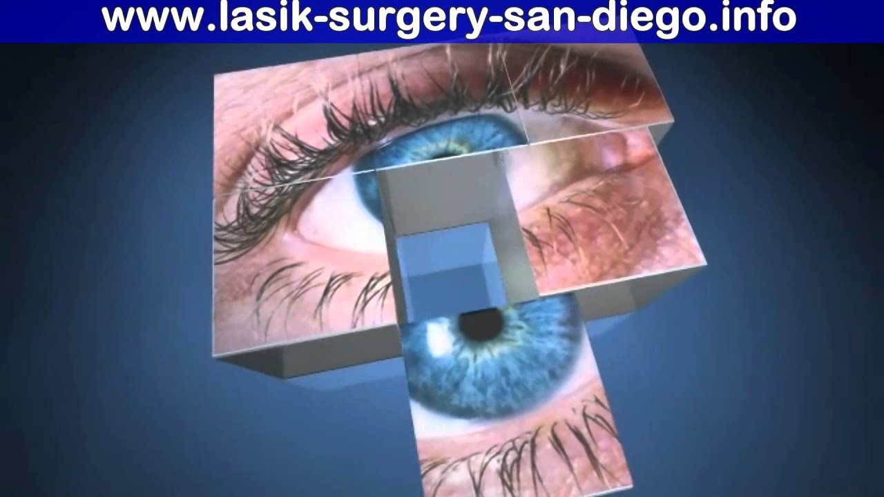 San Diego Lasik