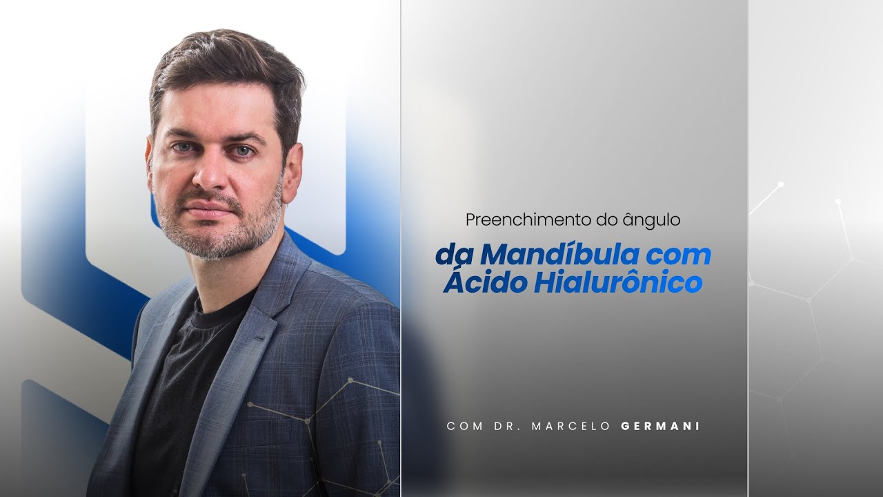Preenchendo o ângulo da mandíbula com ácido hialurônico