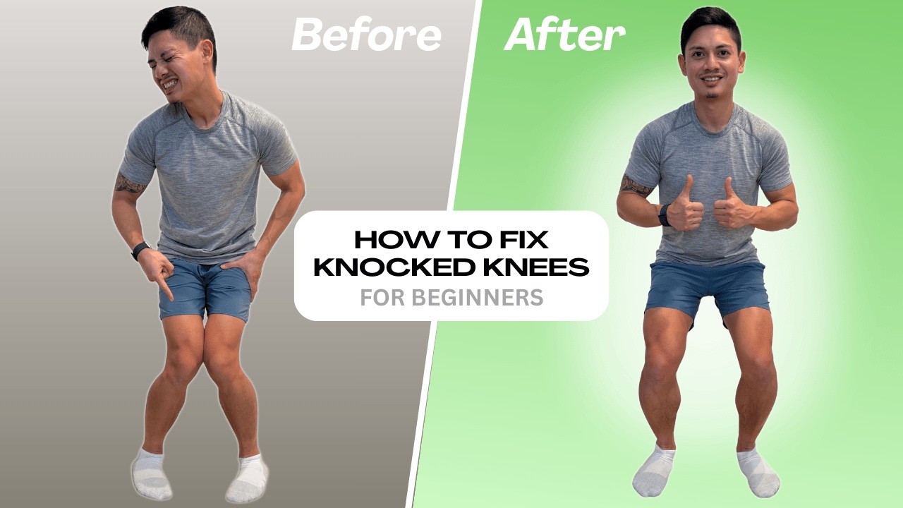 How to Fix Knocked Knees (For Beginners) - 3 Exercises That Work