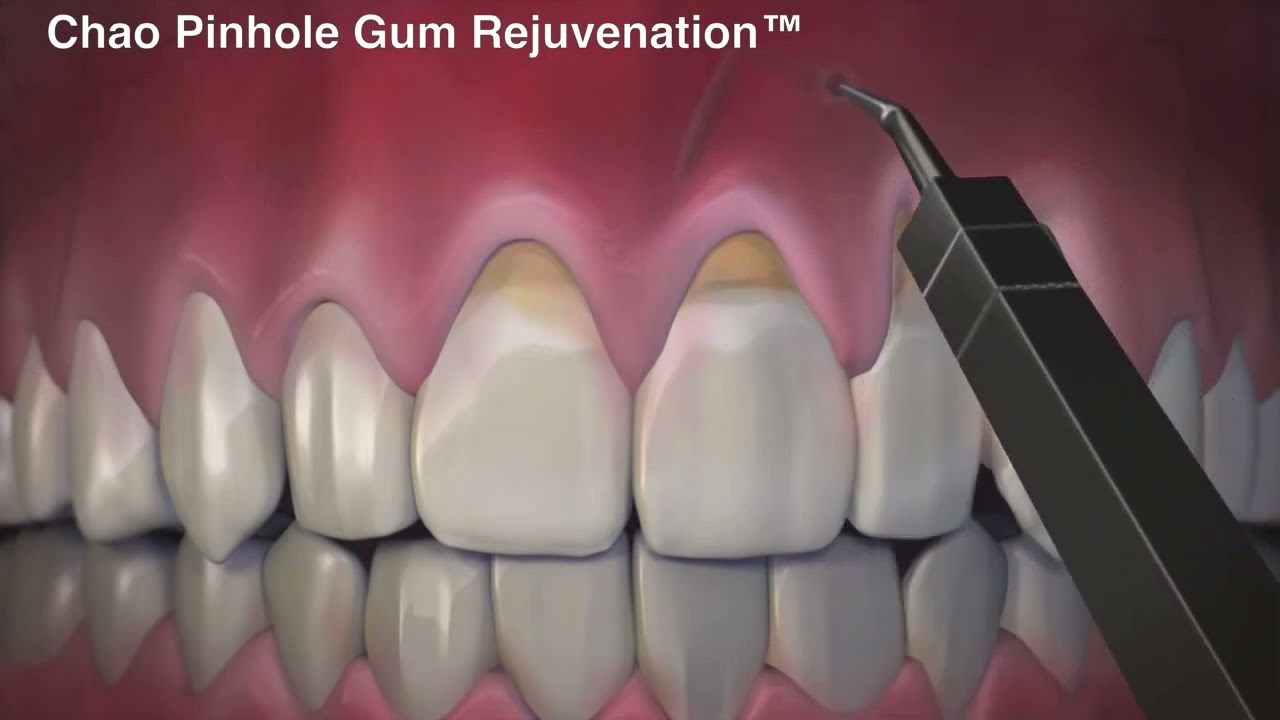 Regenerare gingivala