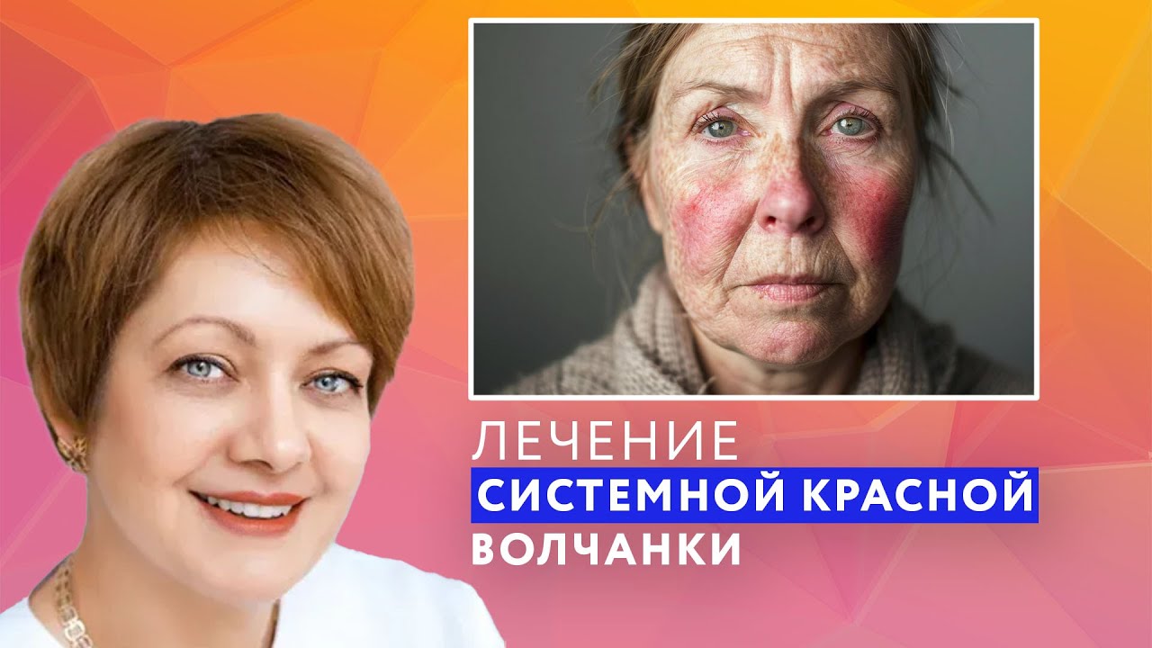 ЛЕЧЕНИЕ СИСТЕМНОЙ КРАСНОЙ ВОЛЧАНКИ // #zdravclinic
