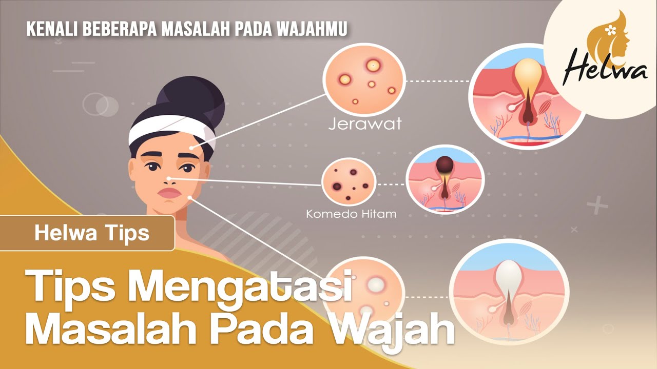 Tips Mengatasi Jerawat dan Komedo di Wajah