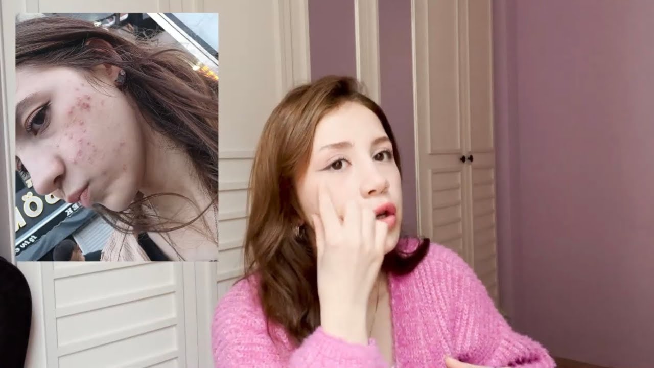 DERMAPEN VE ZORETANİN DENEYİMİM  İŞE YARADI MI