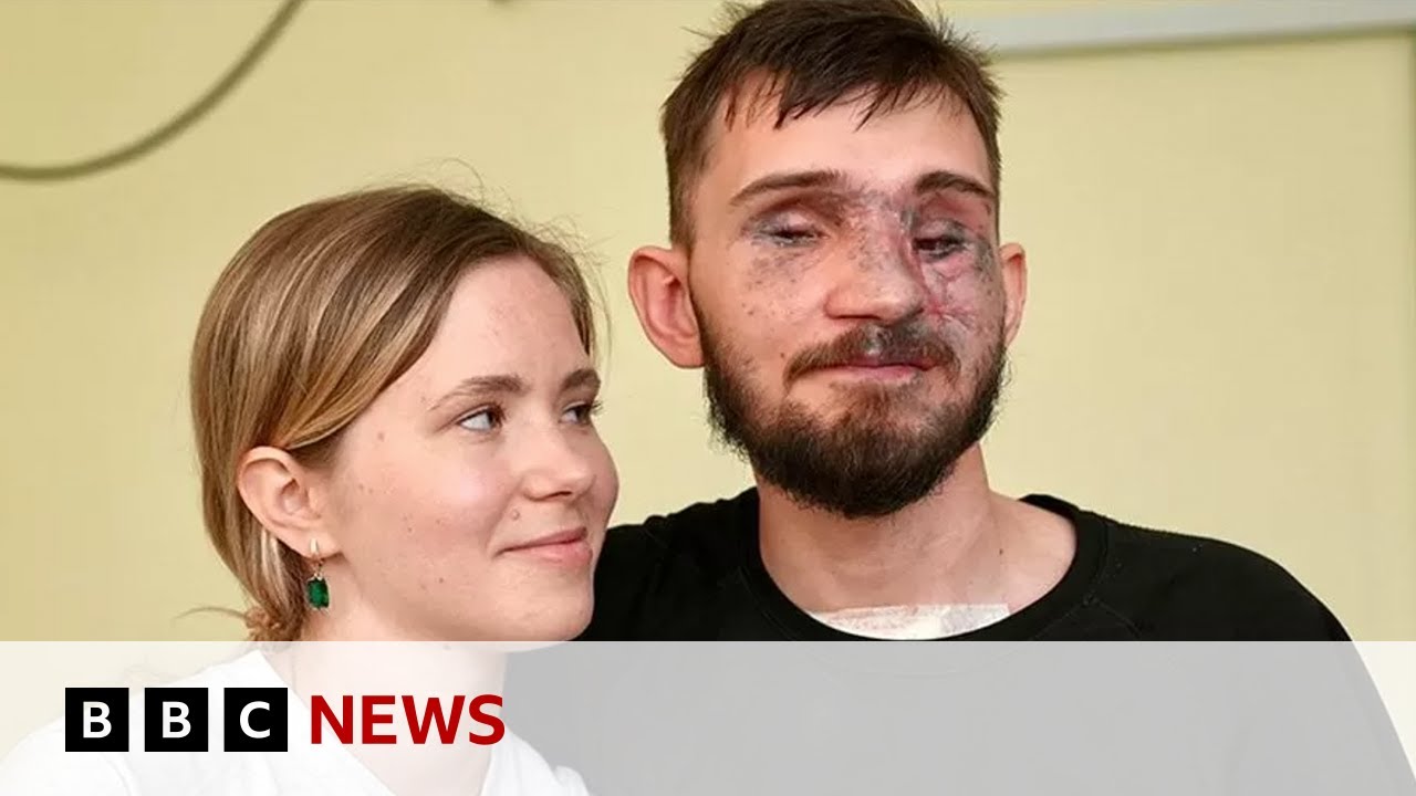 How Ukraine's war wounded repair their lives - BBC News
