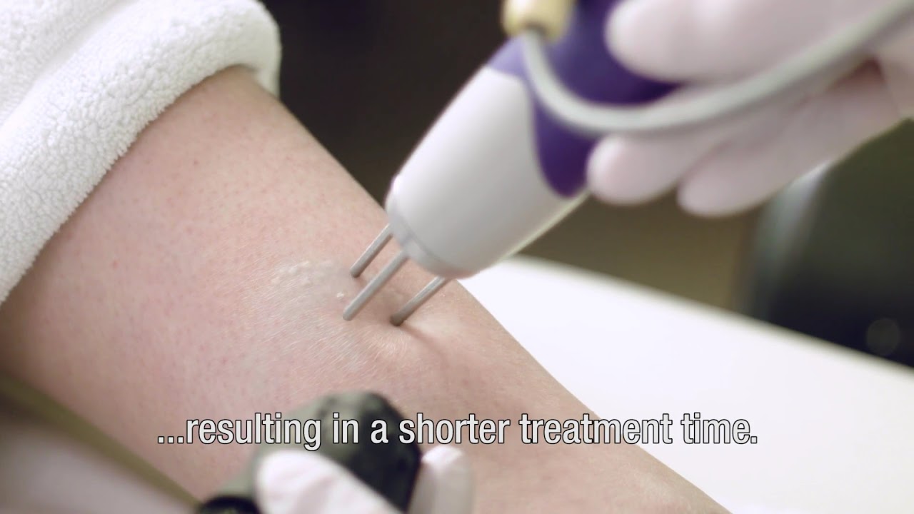 Tatoeage verwijdering / Laser tattoo removal