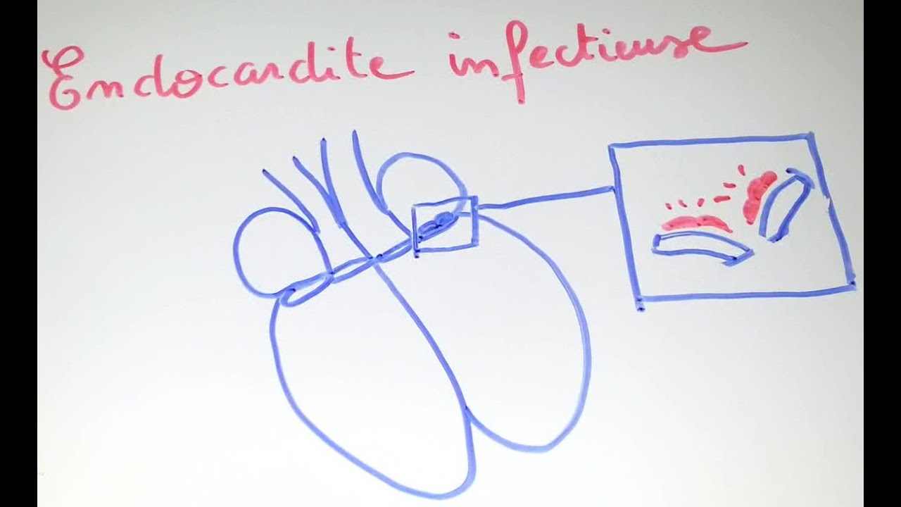 SmartN'Easy - Endocardite infectieuse ! - Dr Astuce
