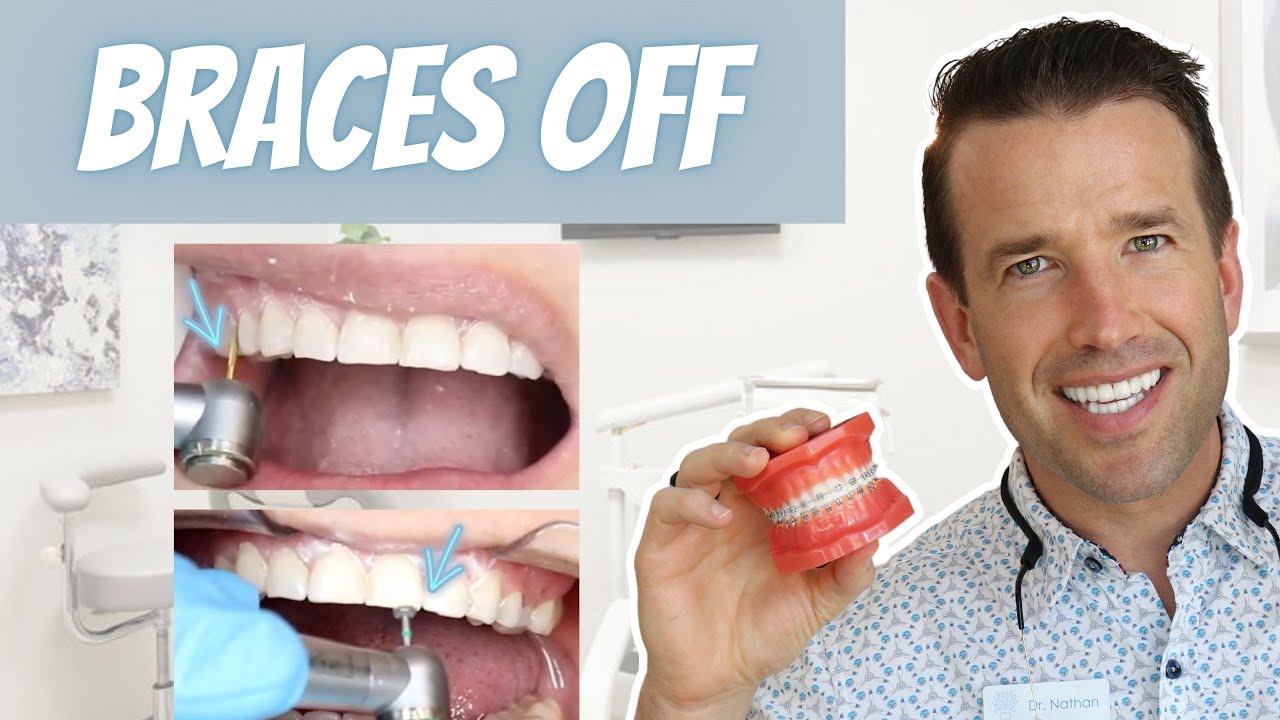 How to Remove Braces | Smoothing Teeth