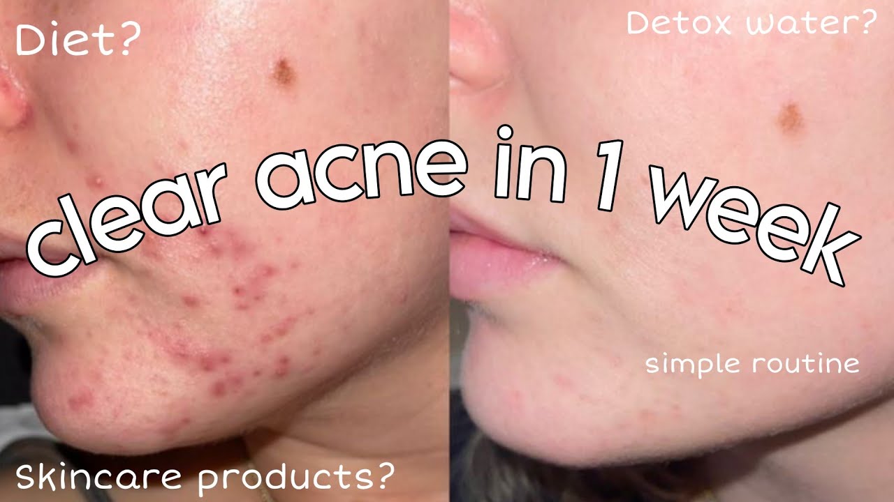 How i clear my acne fast | Diet, Detox Water & Skincare That Actually Works ✅