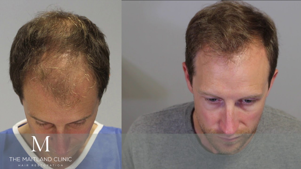 Hair Transplant Surgery Before After, FUE 1895 Grafts, One Year