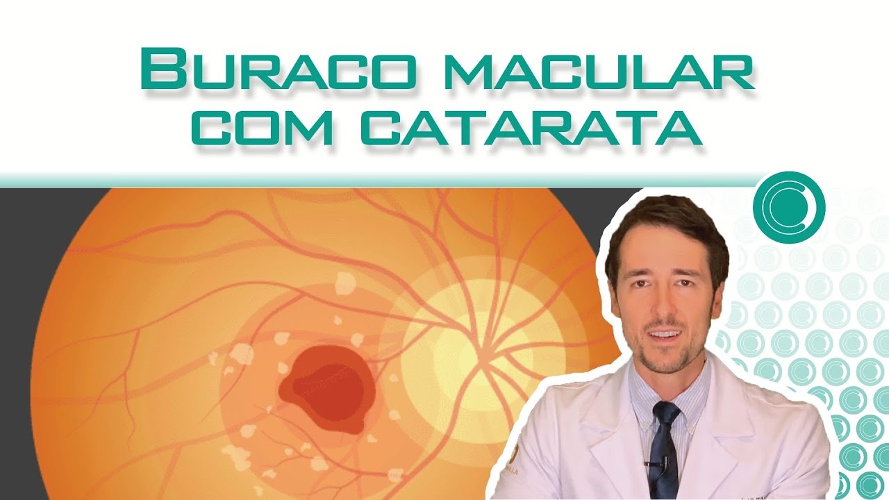 Posso operar buraco macular junto com catarata?