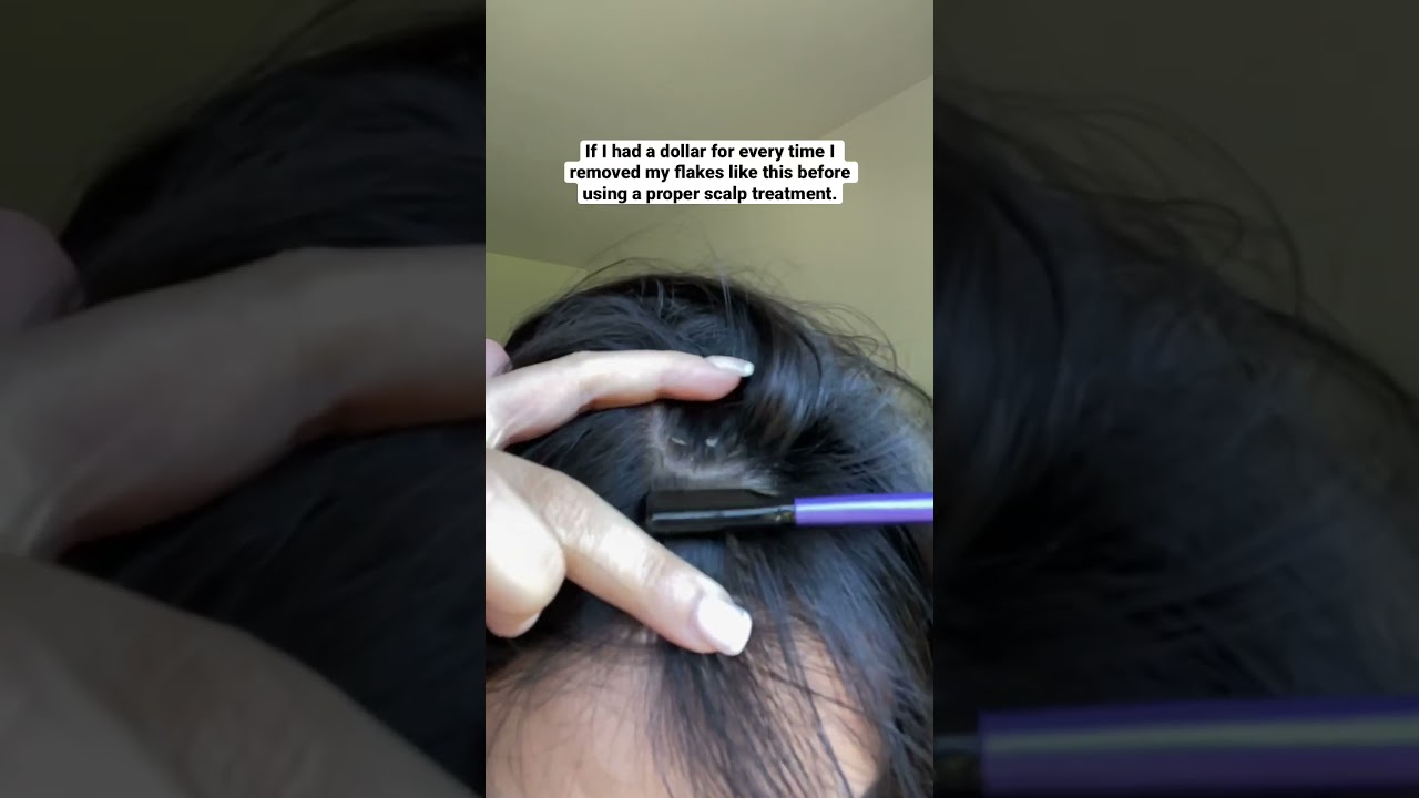 Seborrheic Dermatitis | Act+Acre