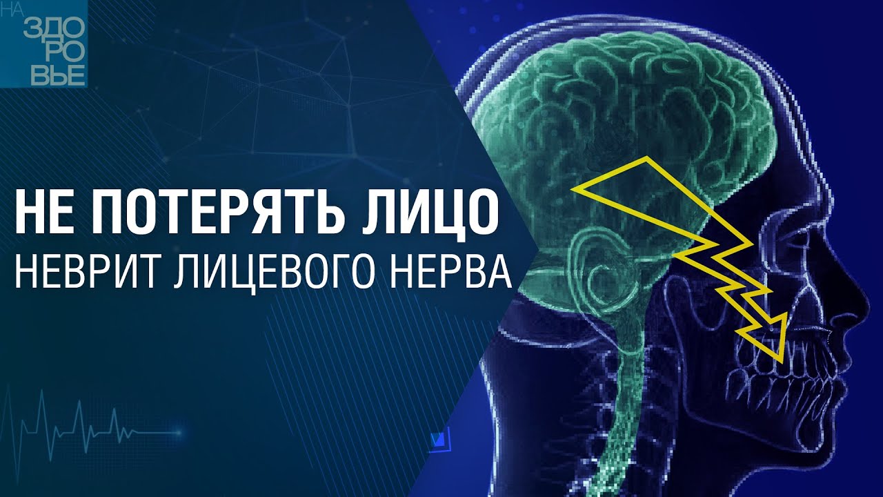 Не потерять лицо. Неврит лицевого нерва. На здоровье 01.06.2024
