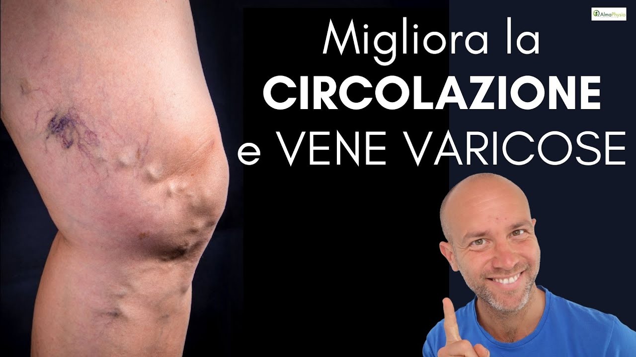 VARICI, cattiva circolazione VENE VARICOSE 👉  consigli pratici