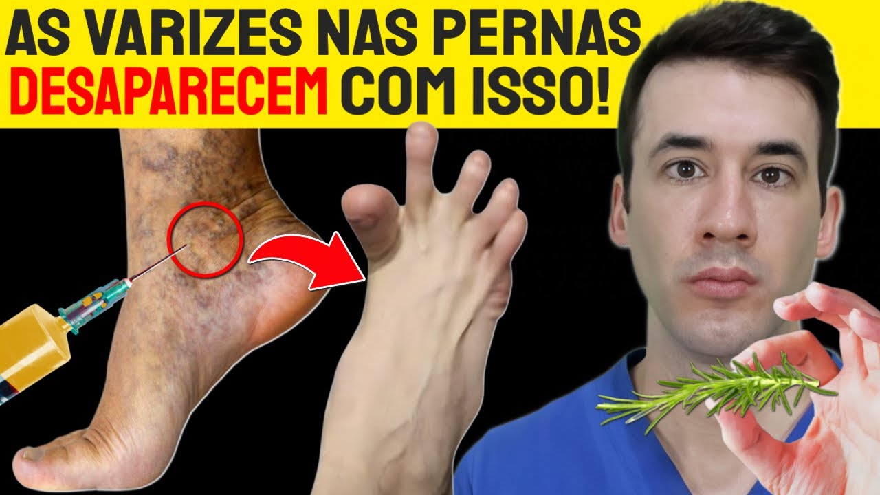 Varizes nas Pernas Desaparecem com Este SEGREDO! - Melhore a Circulação e Elimine Vasinhos