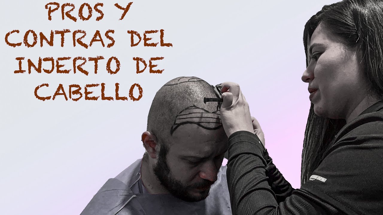 Lo que tienes que saber del INJERTO de CABELLO.
