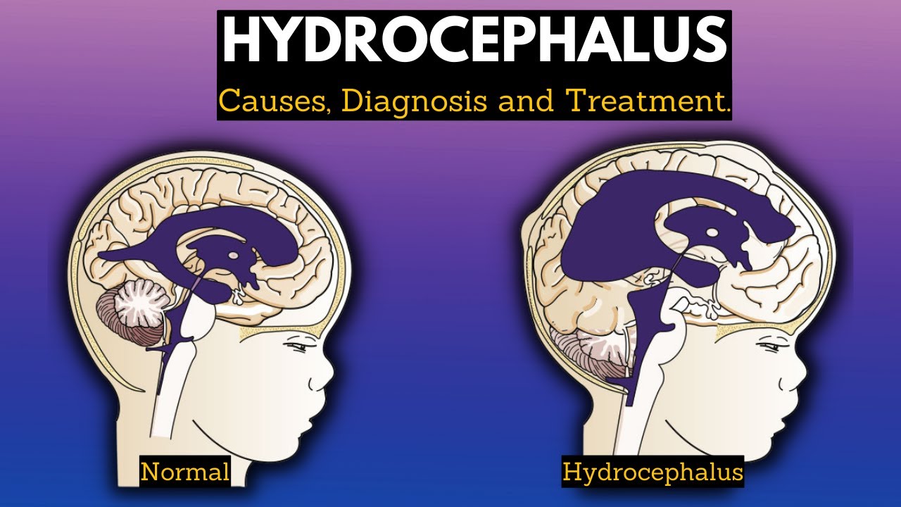 Hydrocephalus, Causes, Signs and Symptoms, Diagnosis and Treatment.