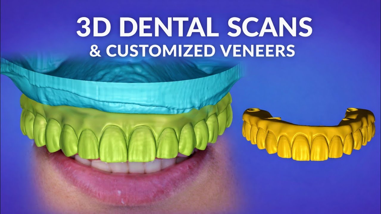 Smile Design Mock-Up for Teeth 13&ndash;23 | Exocad Aesthetic Workflow Tutorial