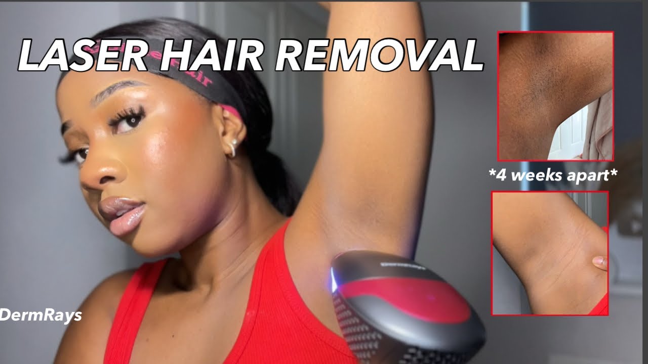 AT HOME LASER HAIR REMOVAL | 4 weeks review using DermRays V6S