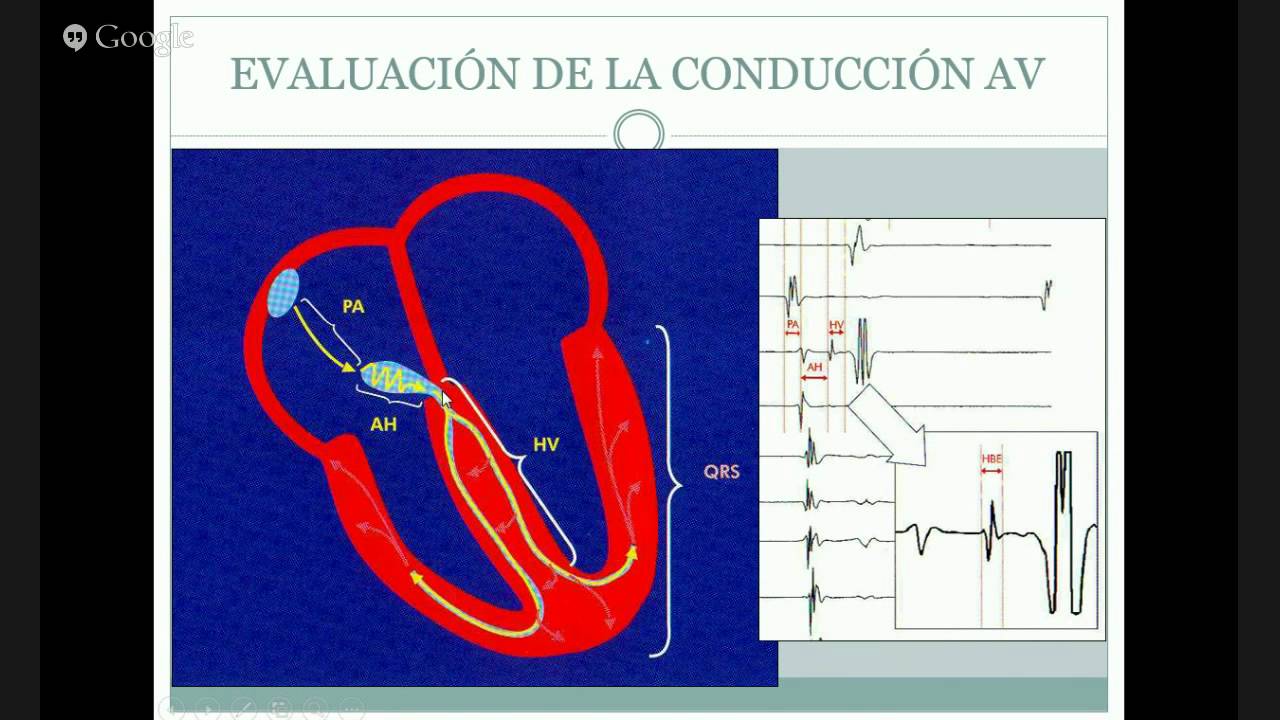 ESTUDIO ELECTROFISIOLOGICO NORMAL